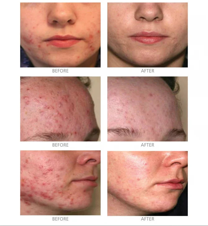 IS Clinical • Active Serum